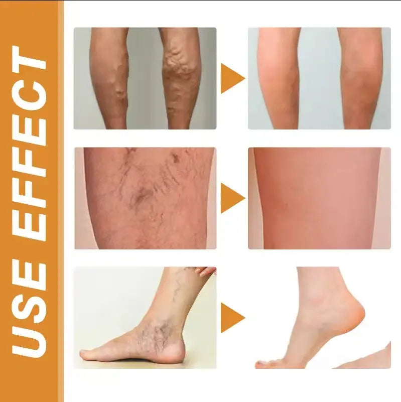 Varicose Vein Relief Spray
