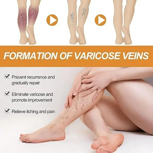 Varicose Vein Relief Spray