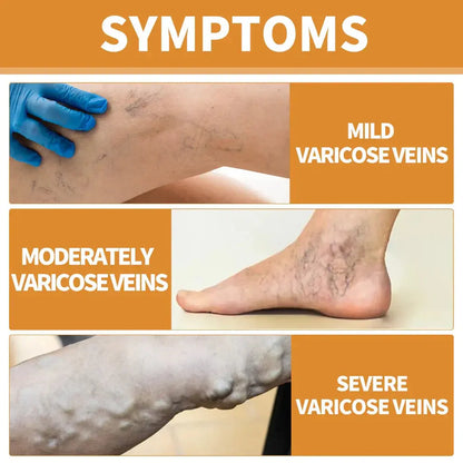 Varicose Vein Relief Spray