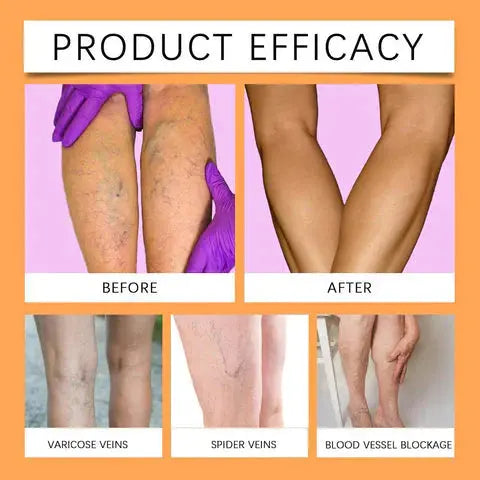 Varicose Vein Relief Spray